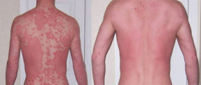 Homeopathy-treatment-for-psoriasis